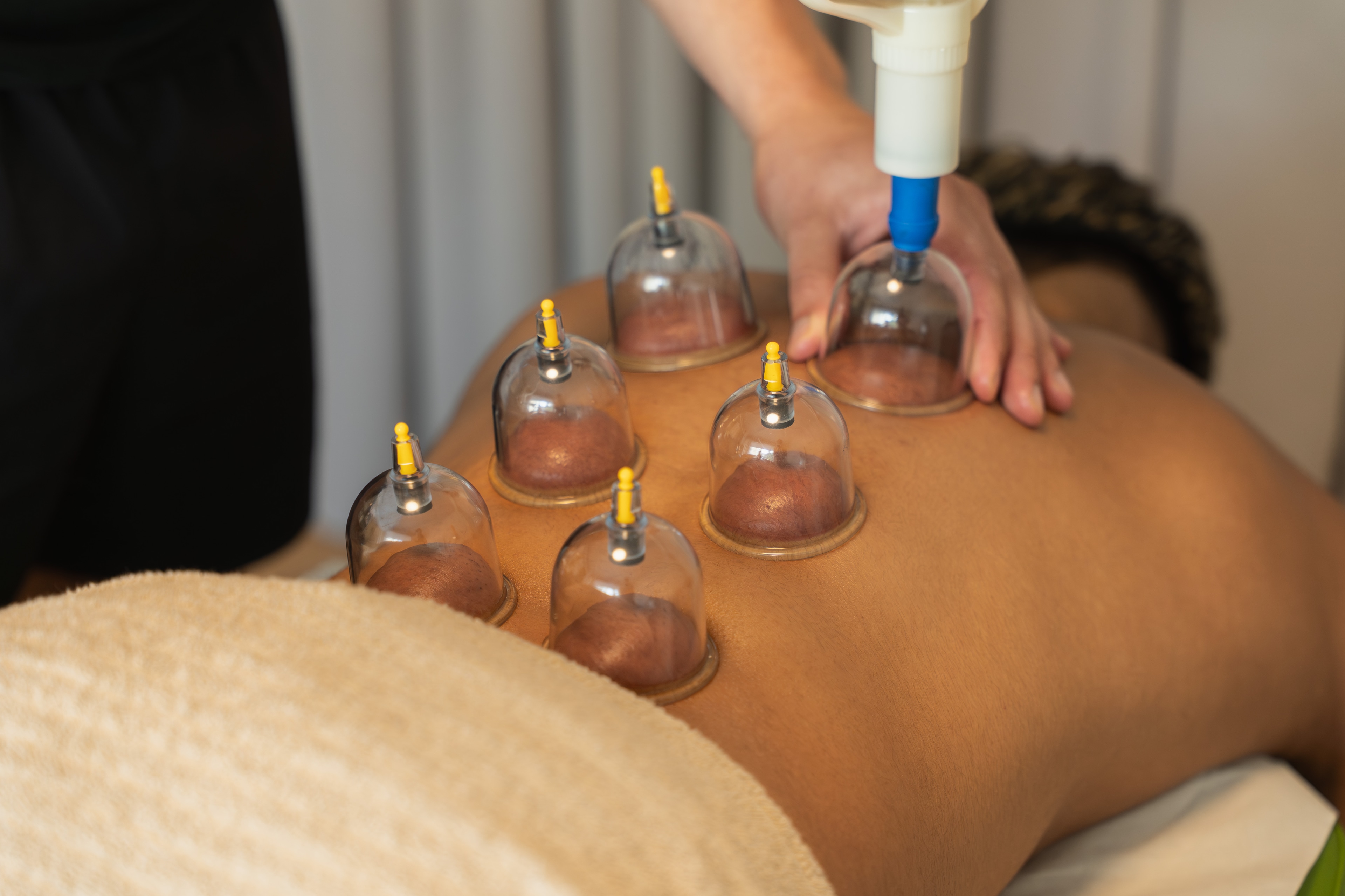 Myofaskiaalinen kuppaus / kuivakuppaus - Leo Pessi hierontapalvelut